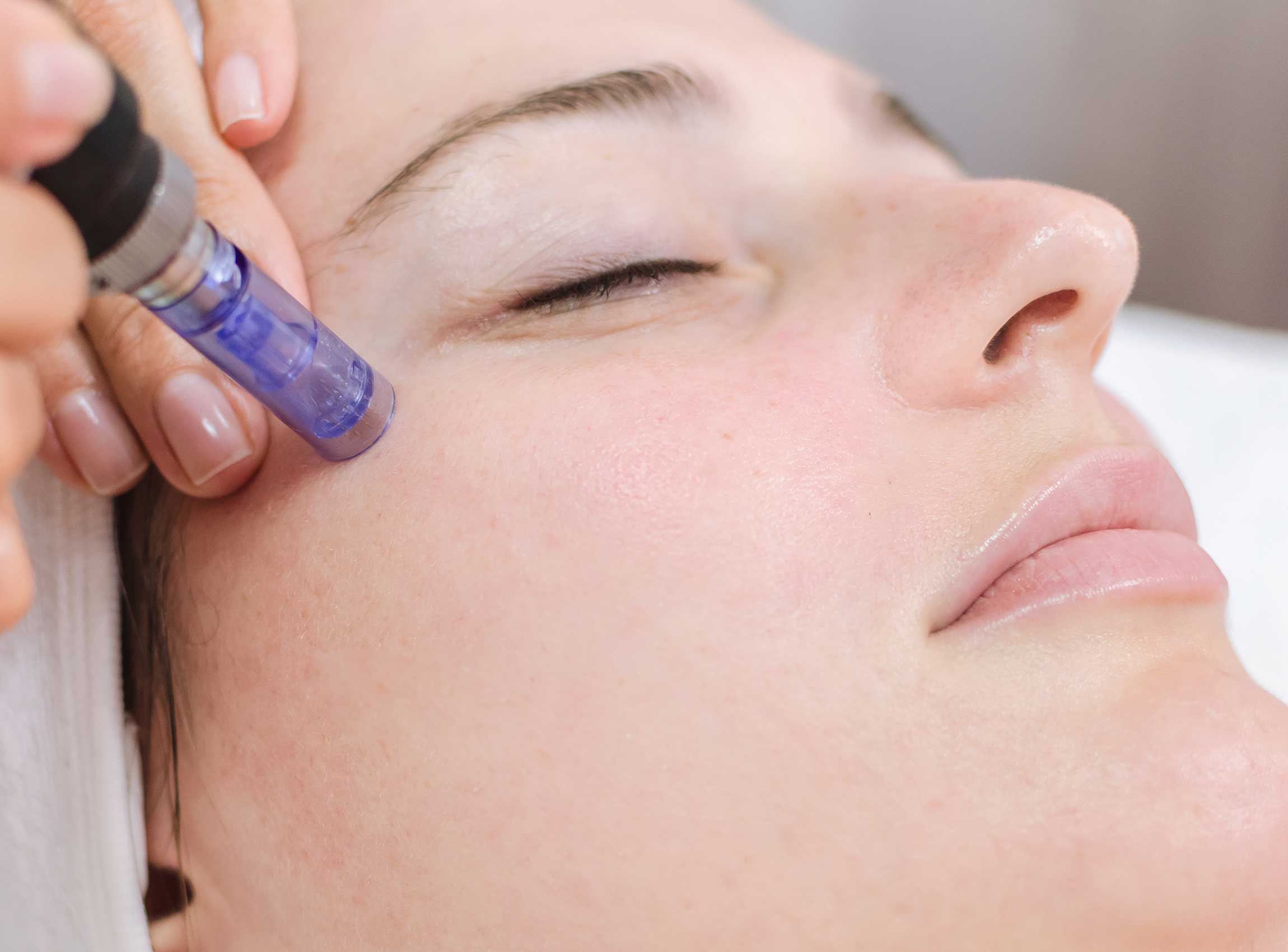 Microneedling